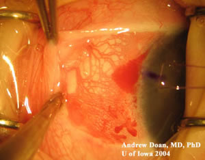 dilated episcleral vessels