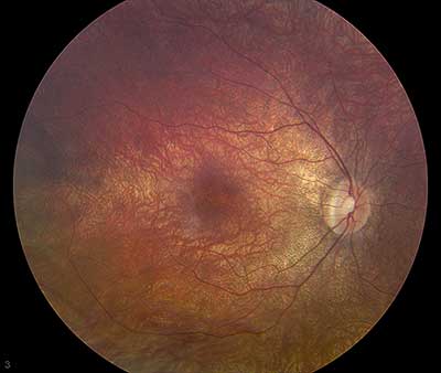 Figure 1. Fundus photo