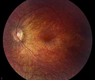 Figure 2. Fundus photo