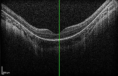 figure 3. OCT with posterior staphylomas