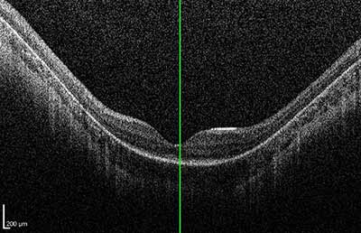 Figure 4. OCT with posterior staphylomas