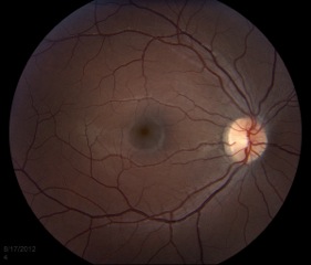 Normal fundus image 