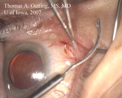 forceps holding open posterior flap of dissection 