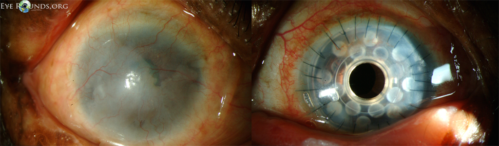  Pre- and post-operative appearance of a Boston Type I KPro device