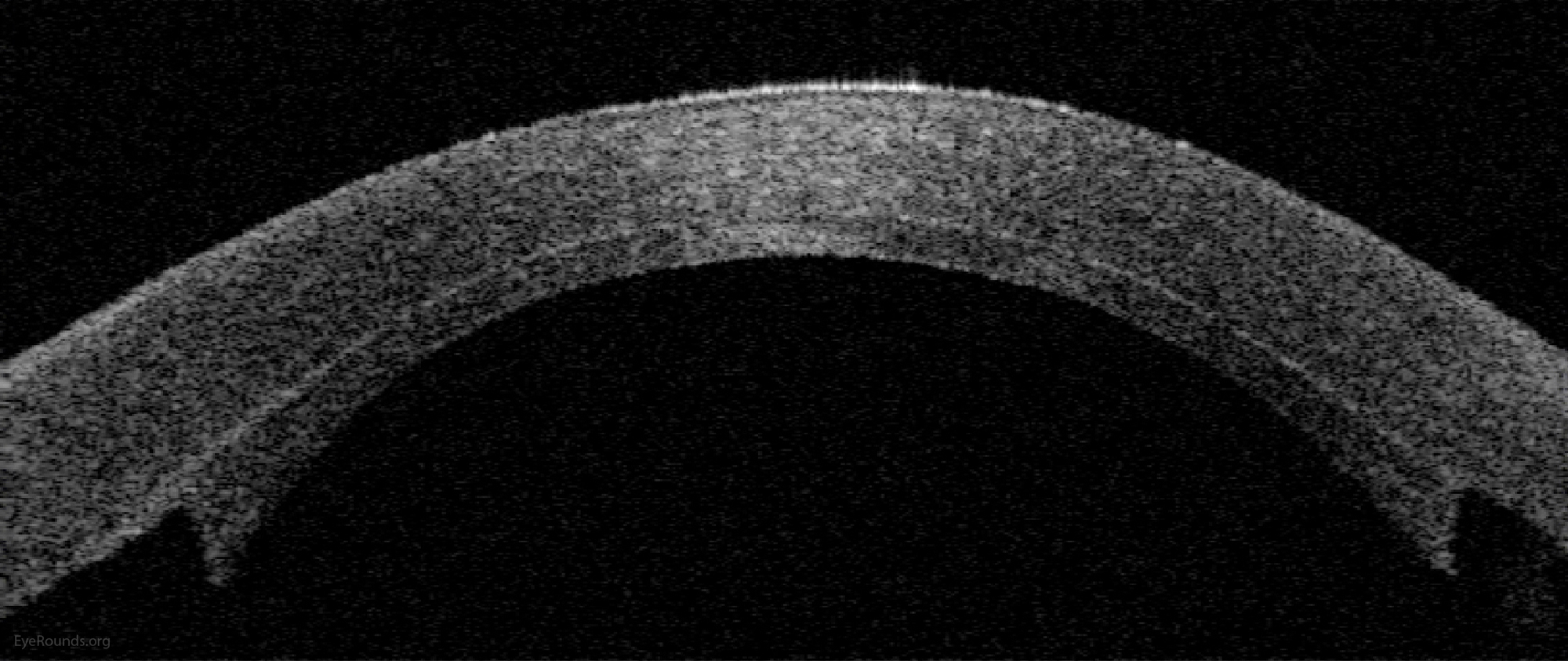  Normal anatomy is restored with reattachment of Descemet membrane