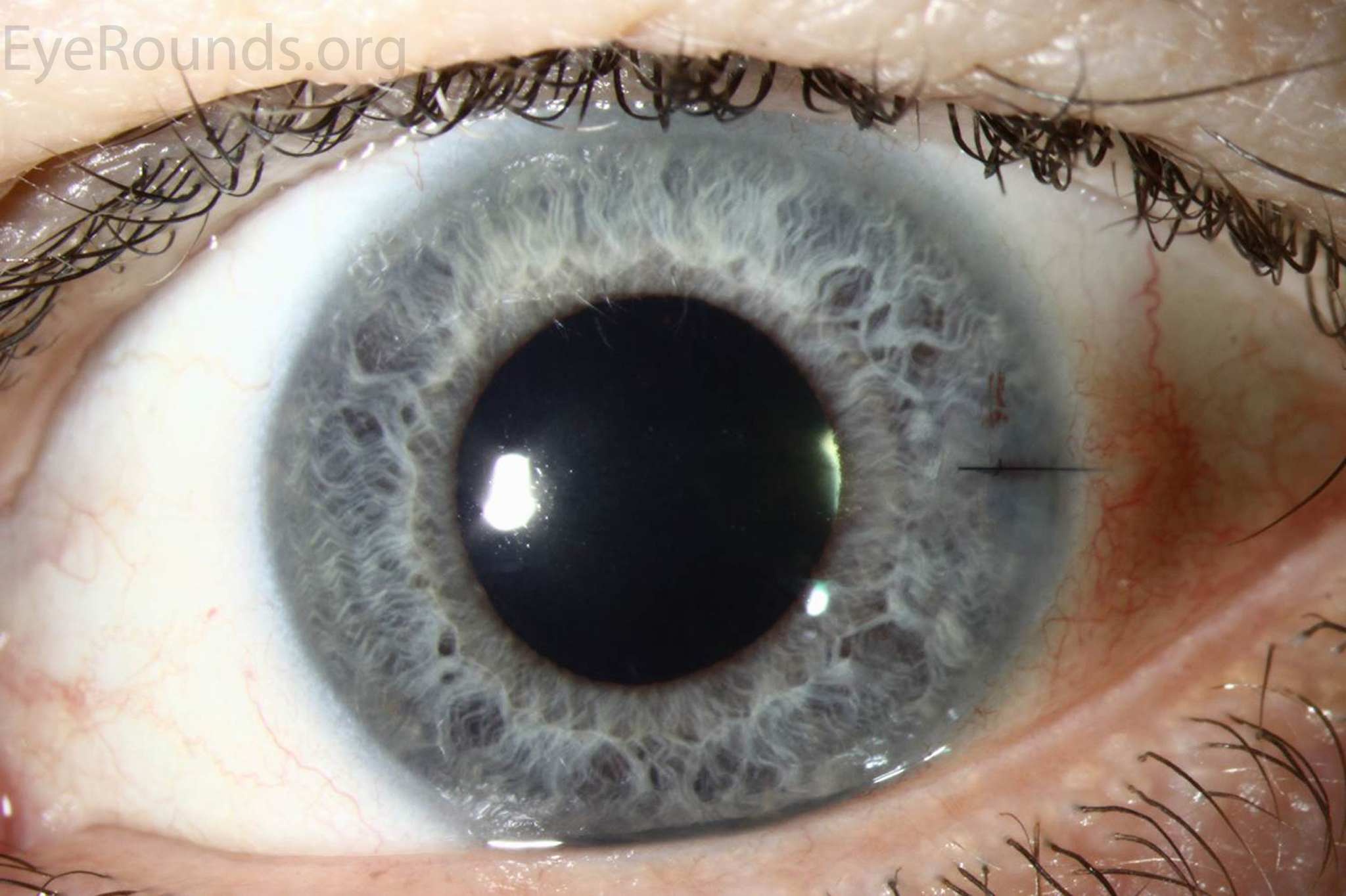  Anterior segment optical coherence tomography