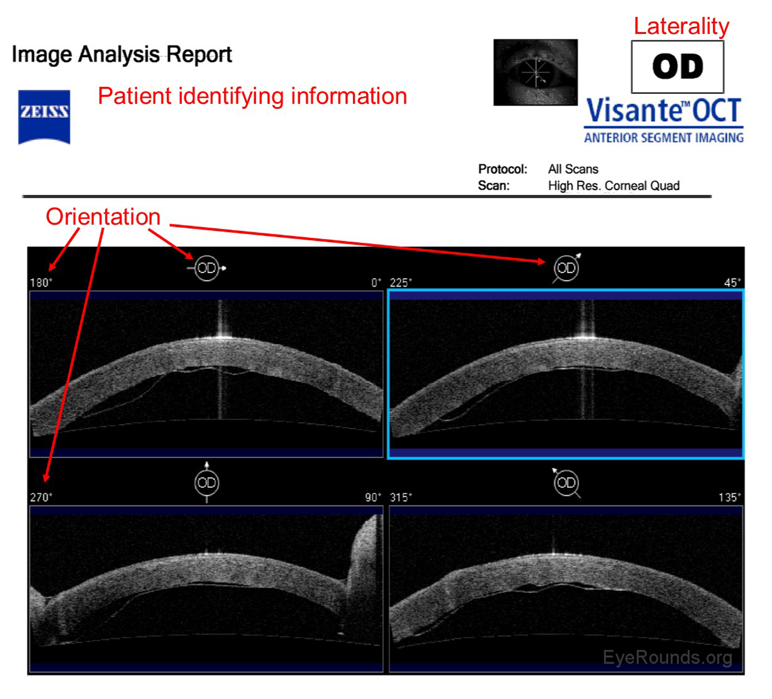 Visante report showing a poorly-adherent Descemets Membrane Endothelial Keratoplasty (DMEK) graft