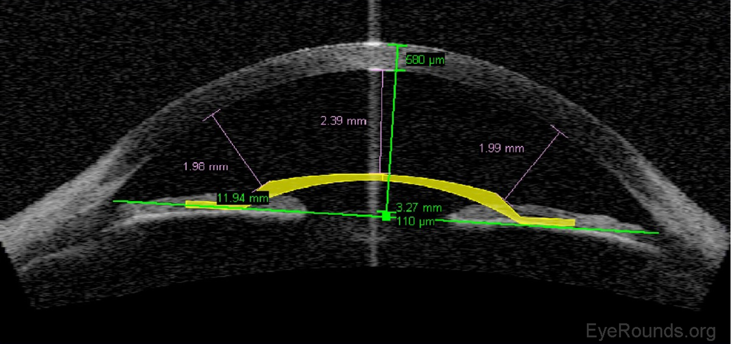 Phakic intraocular lens (IOL) surgical planning on AS-OCT