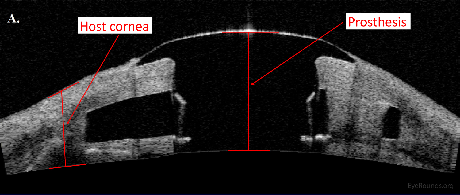 Type I Boston keratoprosthesis device as examined using AS-OCT