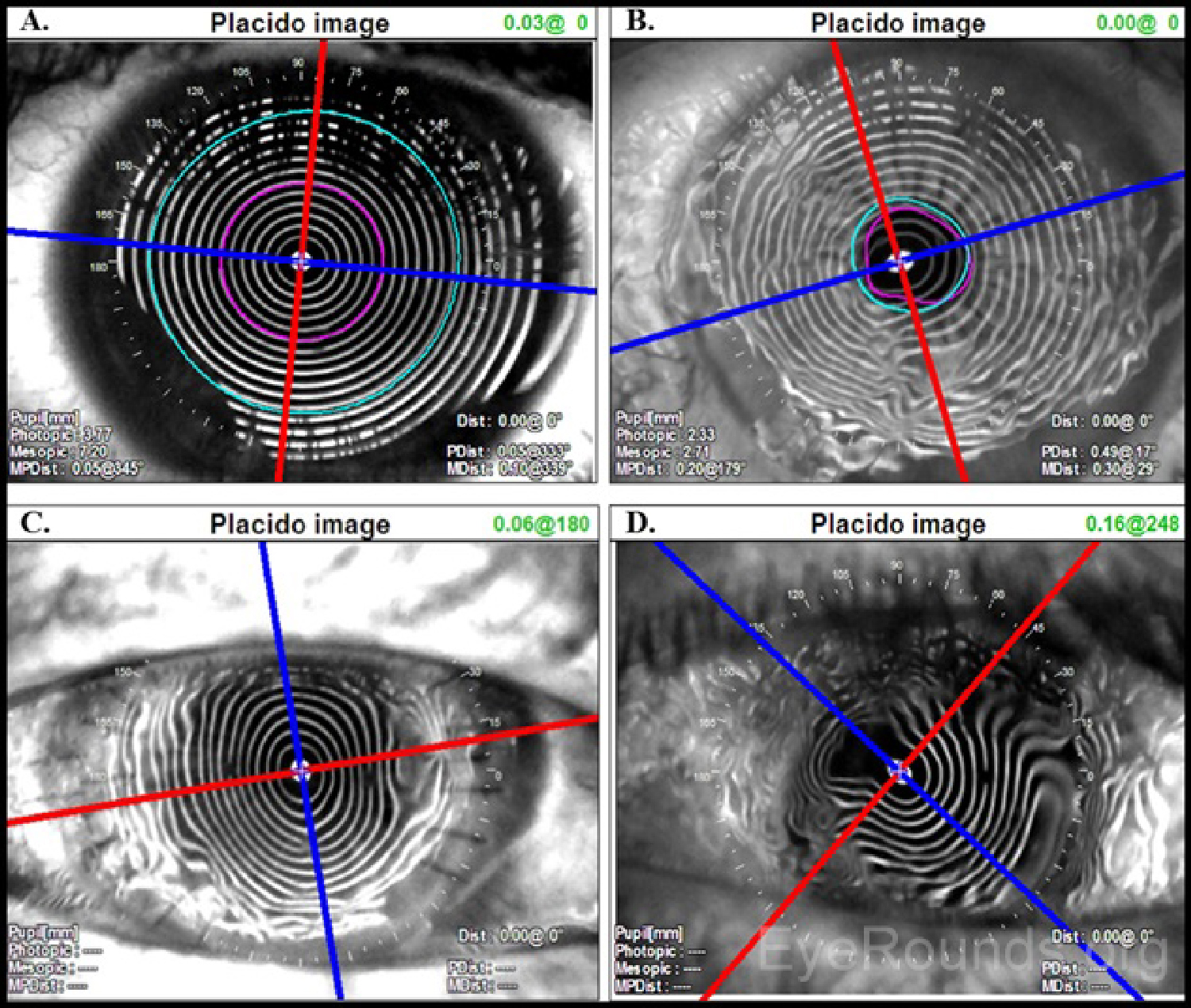 Projection of Placido disc mires on