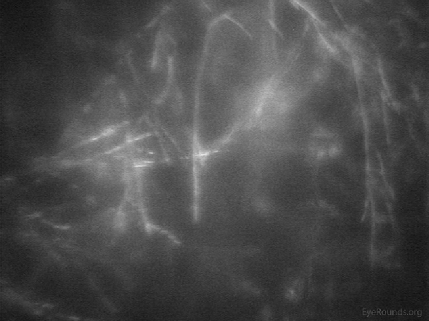 FFungal keratitis seen on confocal microscopy.