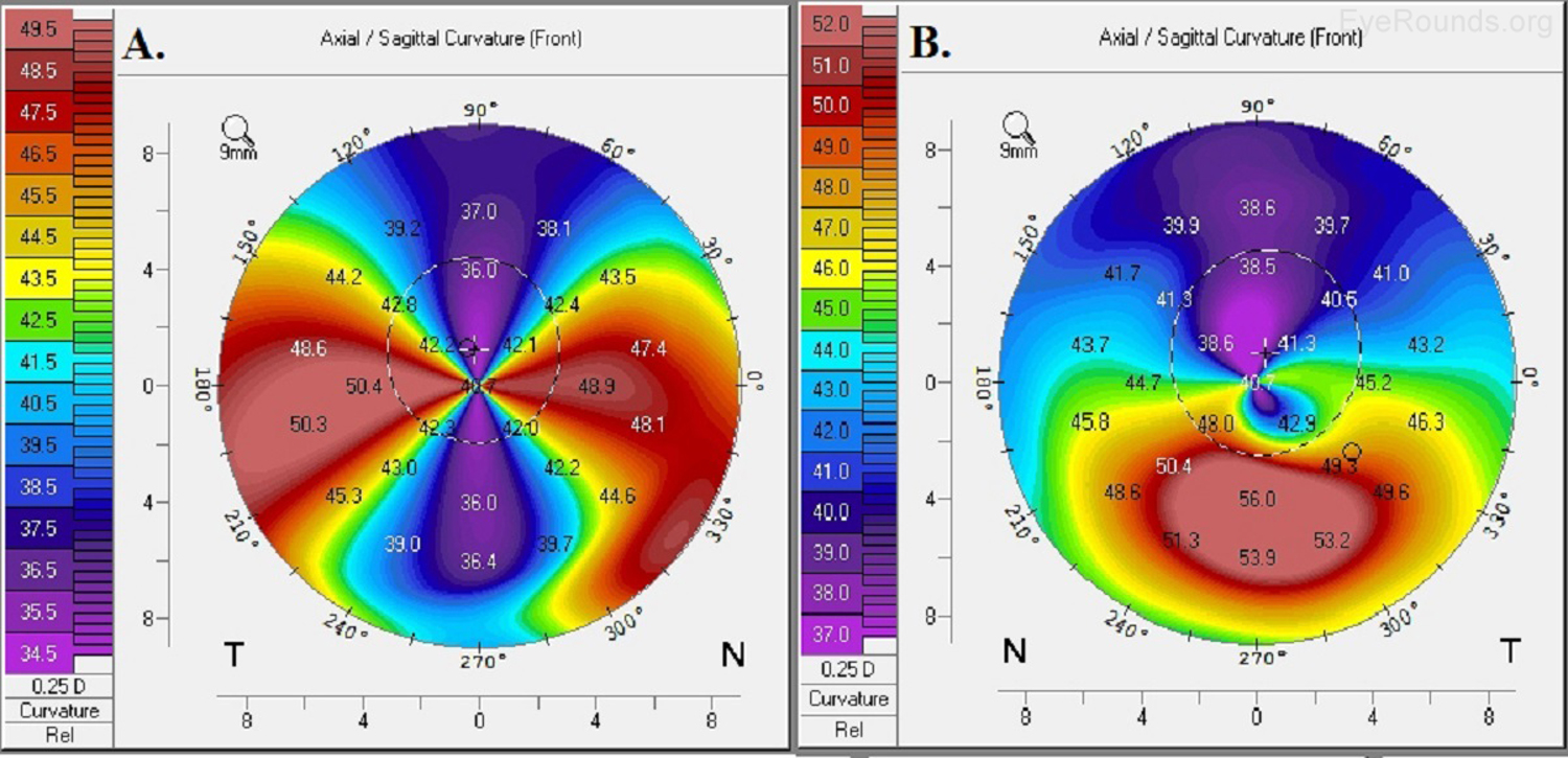 Pellucid marginal corneal degeneration