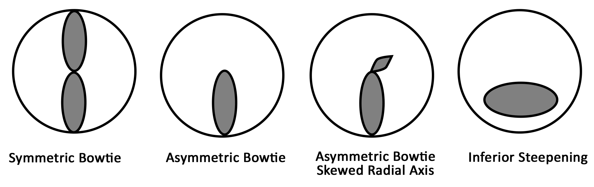 Progression of keratoconus