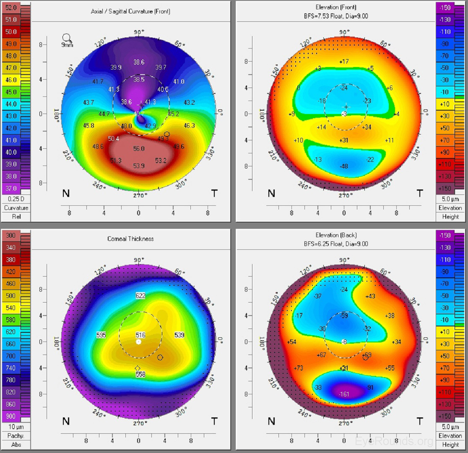 Pellucid marginal corneal degeneration