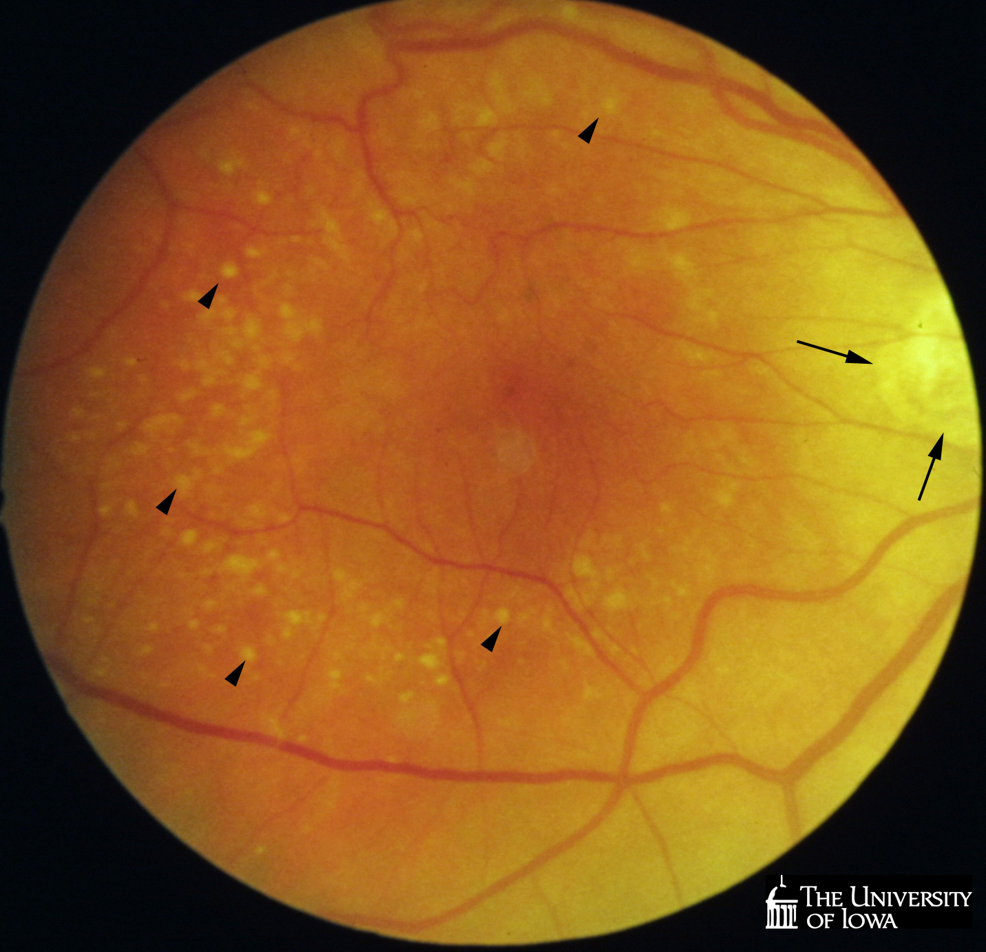 fundus photo pre donation 