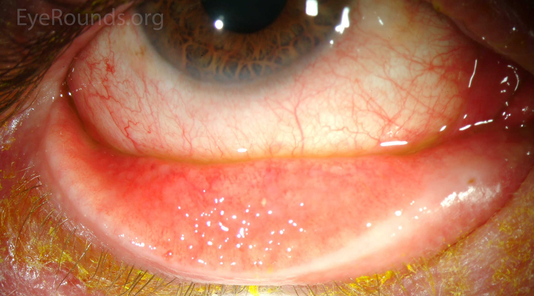 Follicular conjunctivitis from brimonidine use 