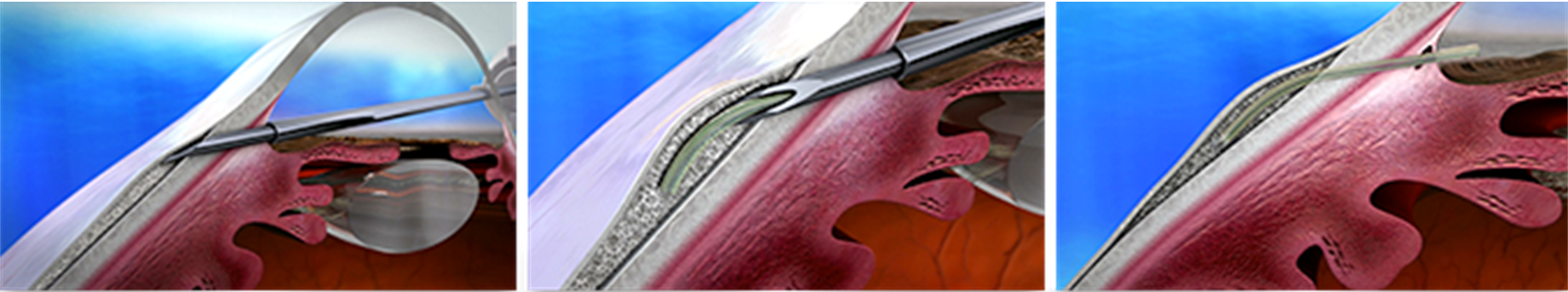 Figure 11. Insertion of the XEN Gel Shunt into Subconjunctival Space. Source: www.aquesys.com/xen  Images used with permission.