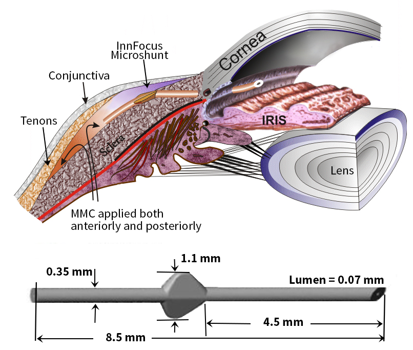 Figure 12. InnFocus Microshunt implanted between subconjunctival space and anterior chamber. Image used with permission from InnFocus, Inc.[30]