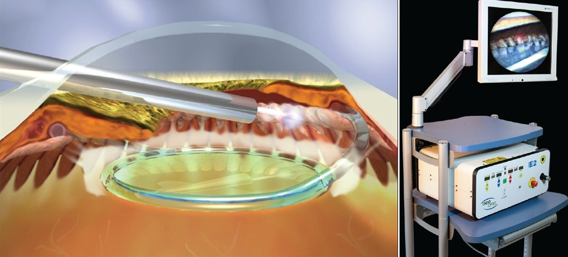 Figure 13. Endocyclophotocoagulation. ECP probe in ciliary sulcus space delivering energy to ciliary processes. Video screen of cryophotocoagulated ciliary processes after ECP procedure. Images used with permission.