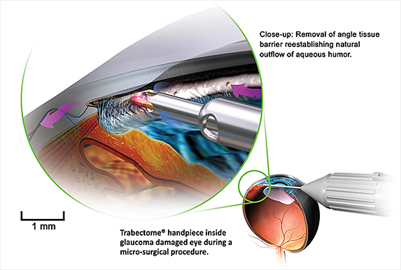 Figure 4. Trabectome Procedure, Handpiece, and Console. Source: NeoMedix Corporation, https://www.neomedix.net/Learning/Library/Images Images used with permission.