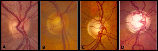  fundus photographs cup to disc ratios