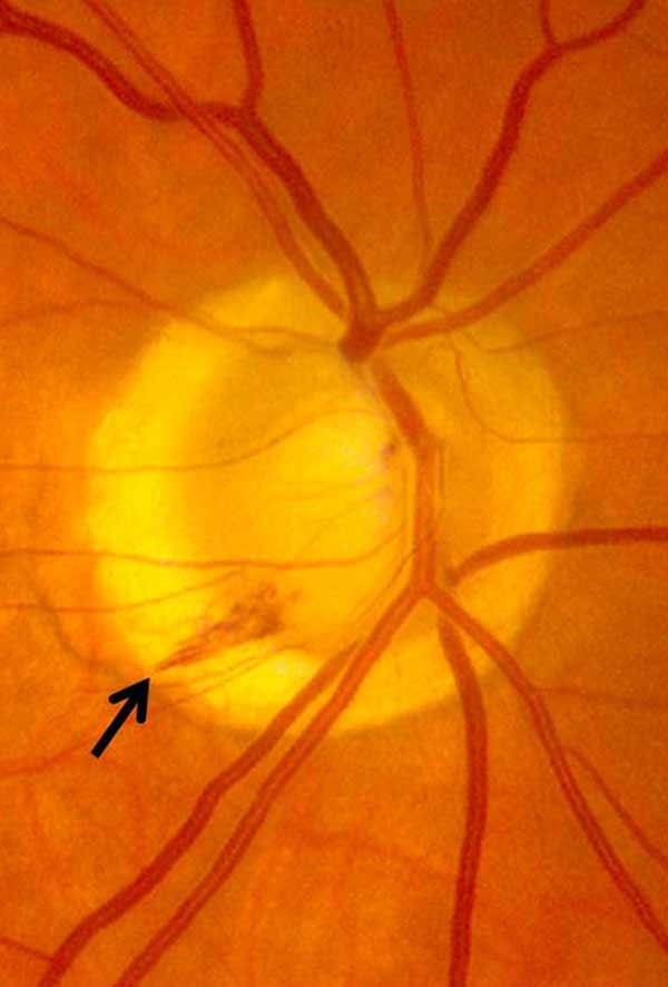 Fundus photograph demonstrating an inferotemporal hemorrhage 