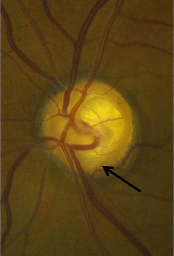 Fundus photograph demonstrating an inferior notch of the neuroretinal rim 