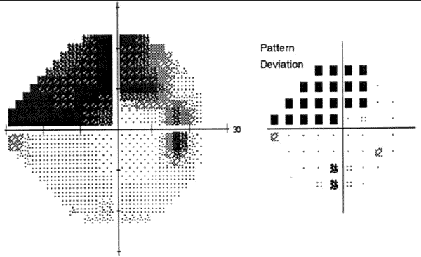  Humphrey Visual Field