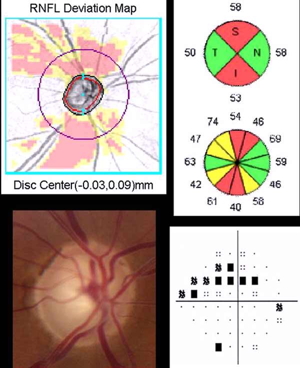  OCT demonstrating superior and inferior thinning of the RNFL