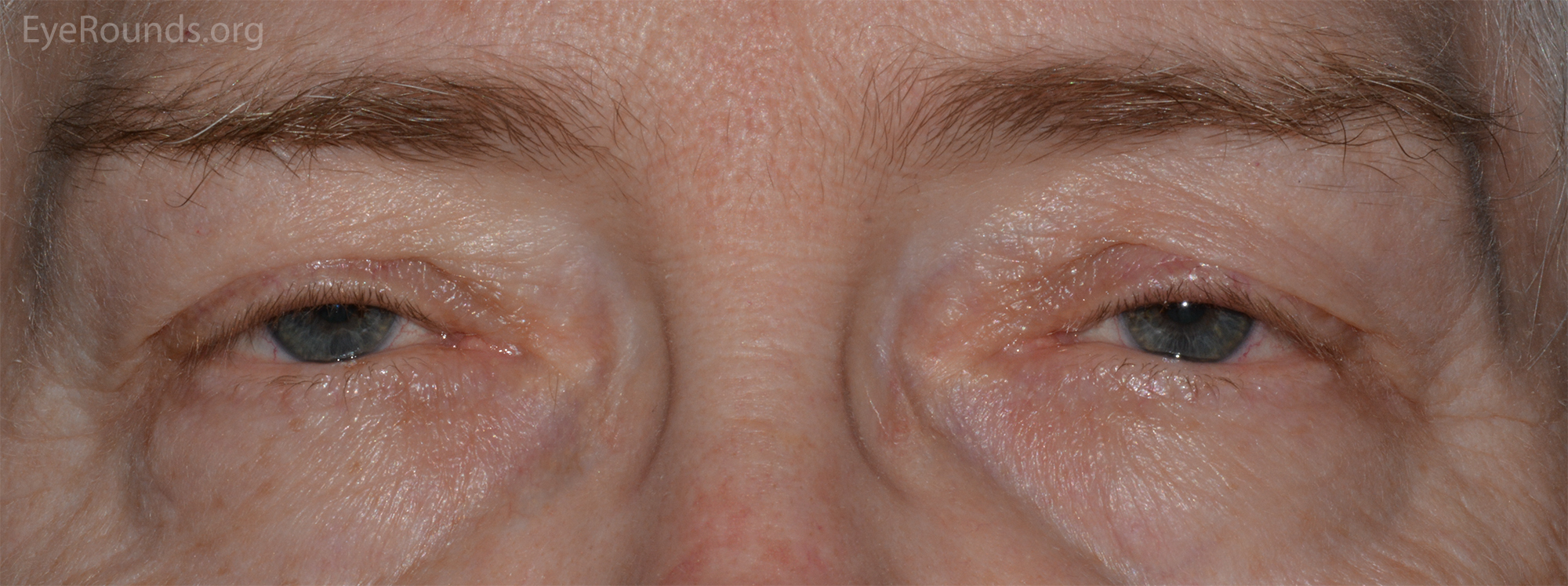 Image of bilateral ptosis