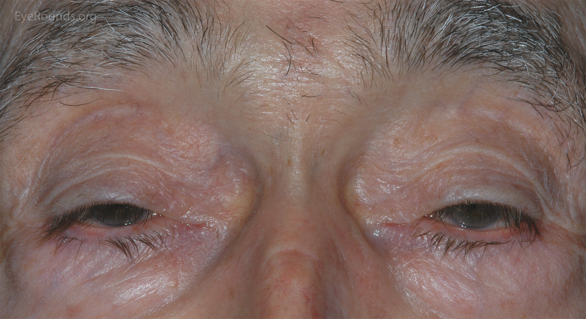 Involutional ptosis