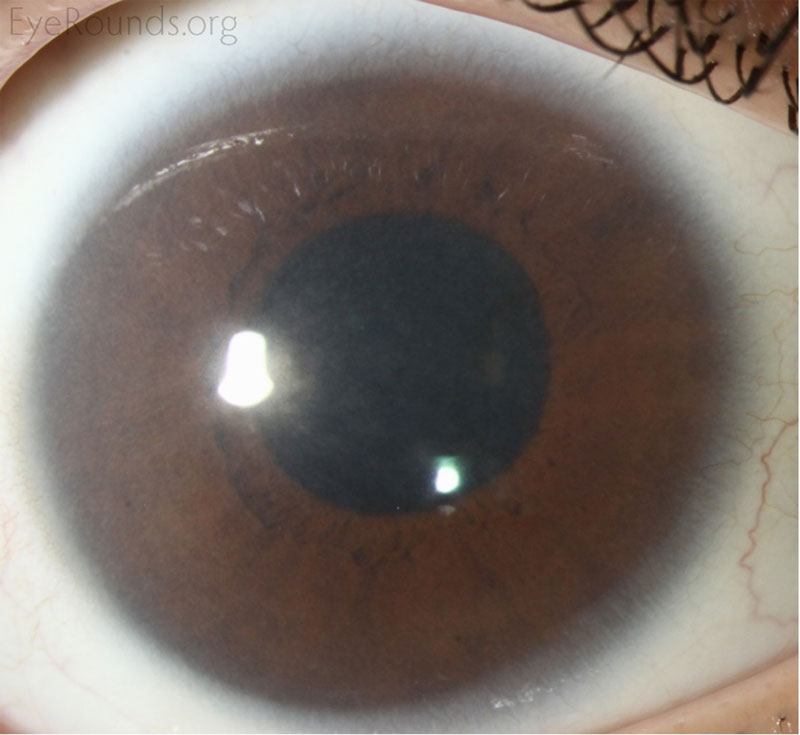 Example of a pediatric cataract that can lead to deprivation amblyopia