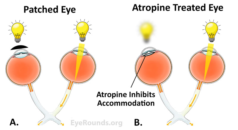 Example of a pediatric cataract that can lead to deprivation amblyopia