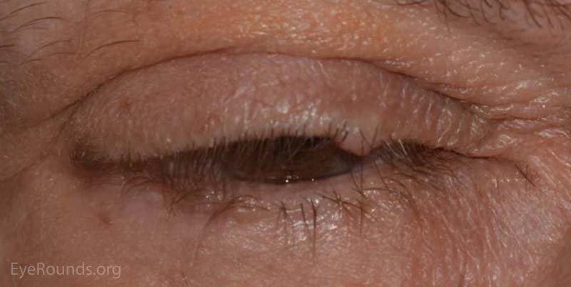 Intradermal nevus