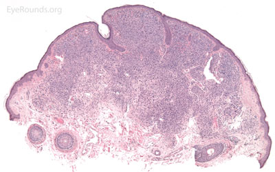 Syringoma pathology  