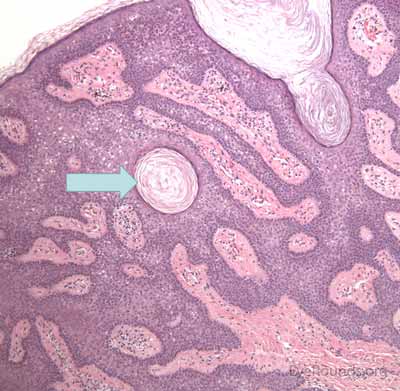 Seborrheic keratosis pathology