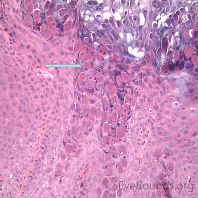 Molluscum contagiosum pathology