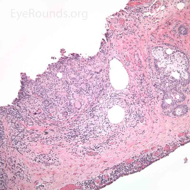 H&E Chalazion pathology 