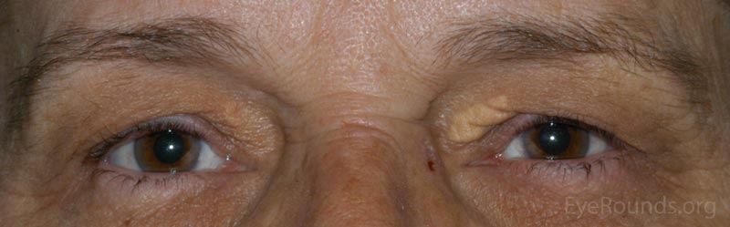 Xanthelasma