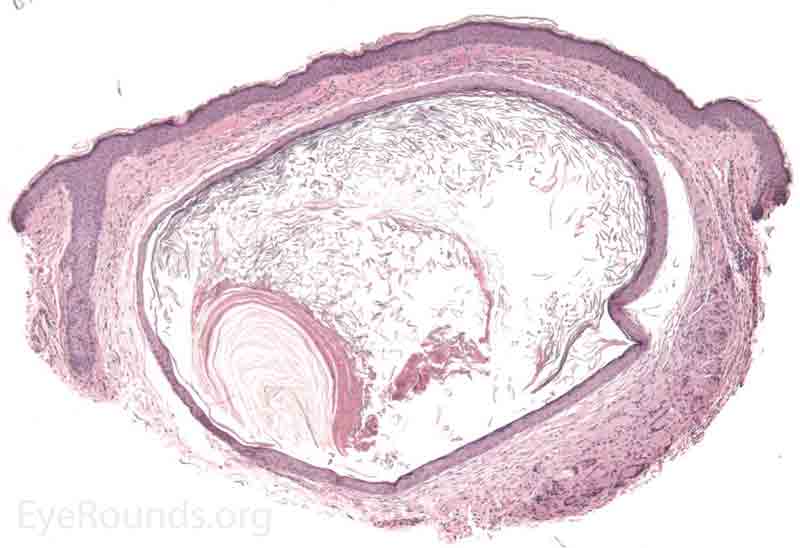 Epidermal inclusion cyst pathology 