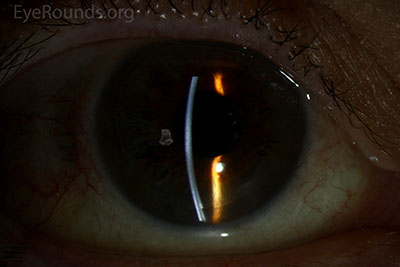 Post-operative appearance after undergoing DSAEK for Fuchs endothelial corneal dystrophy
