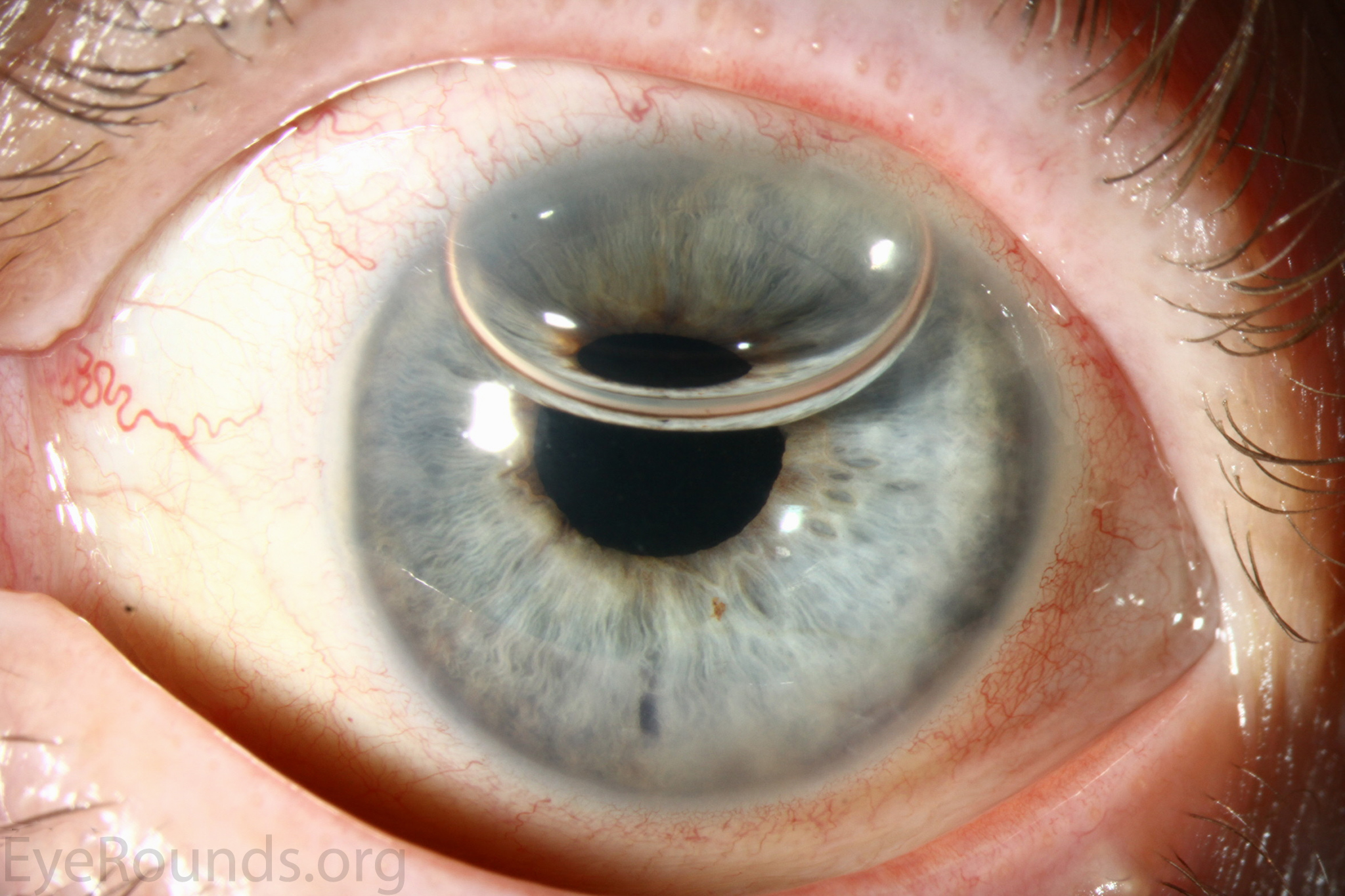 DALK performed for keratoconus