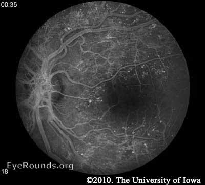 Fluorescein Angiogram