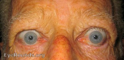  Thyroid Eye Disease. Paitent exhibits classic signs of the diesase.