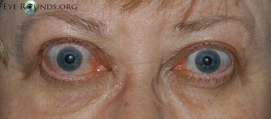  Thyroid Eye Disease. Paitent exhibits classic signs of the diesase.