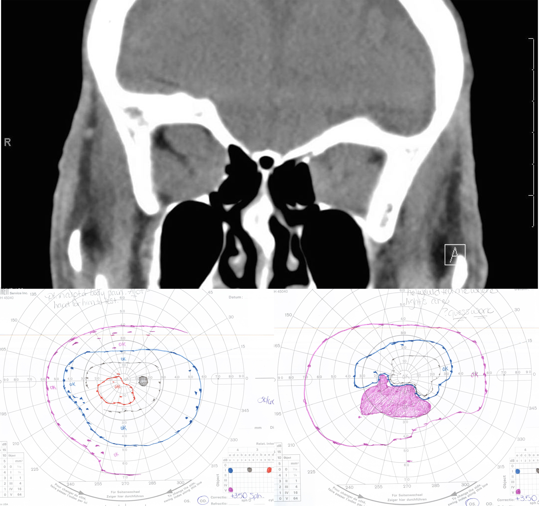 Compressive optic neuropathy