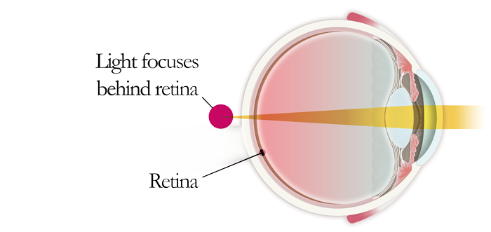 depiction hyperopia