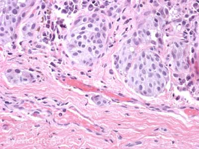 Melanoma Histology 