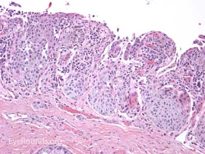 Melanoma Histology 