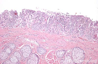 Melanoma Histology 